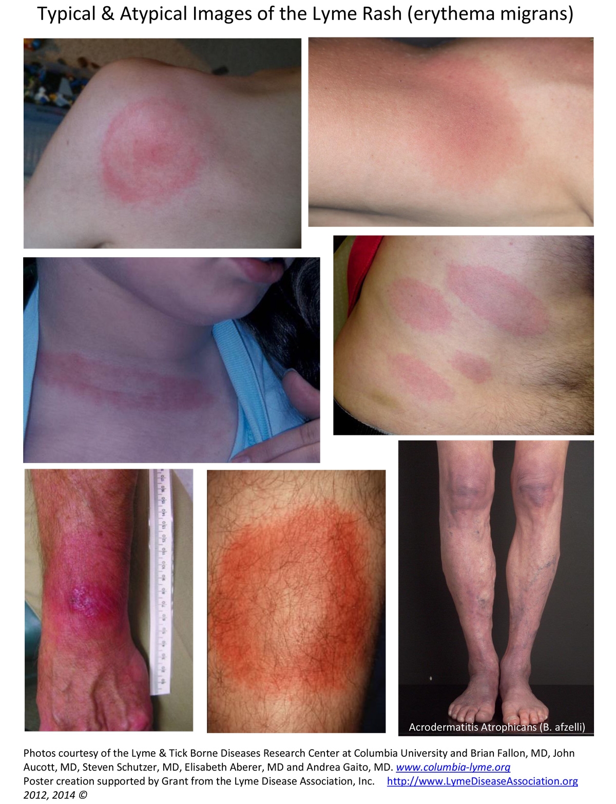 Lyme Rash Identification